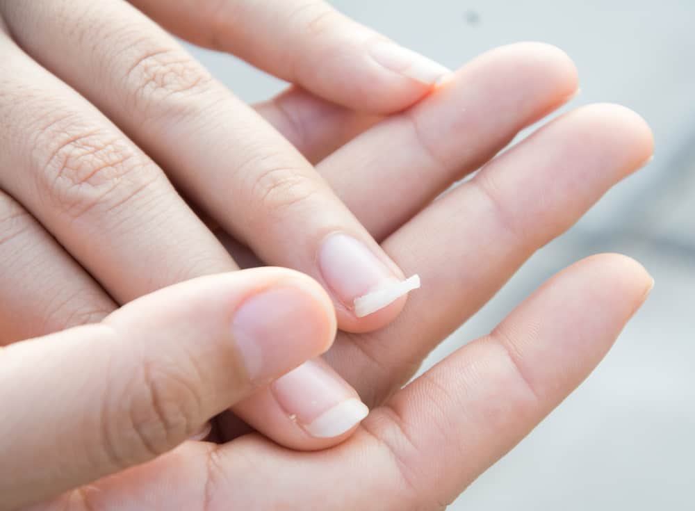 Image of a broken nail hand