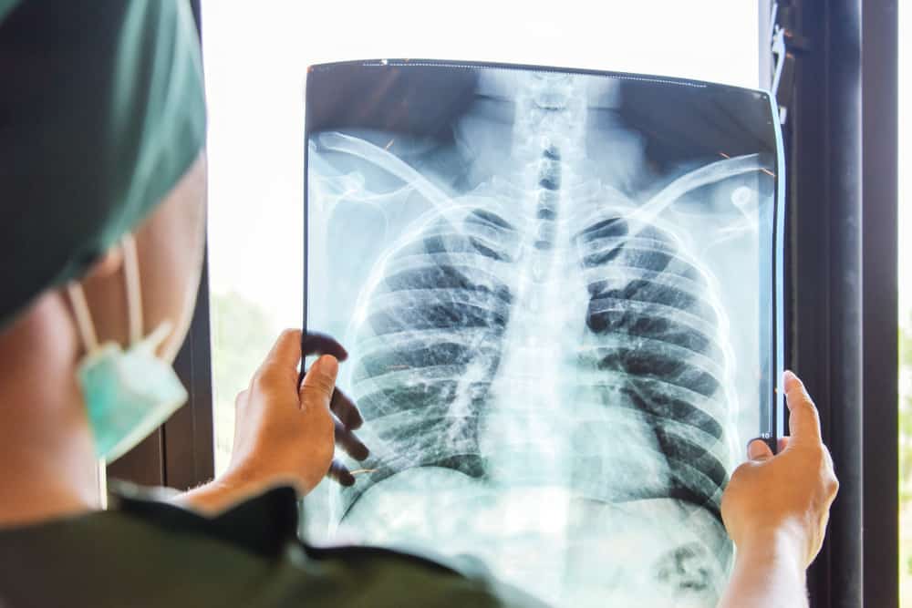 Doctor checking examining chest x-ray film of patient at ward hospital.